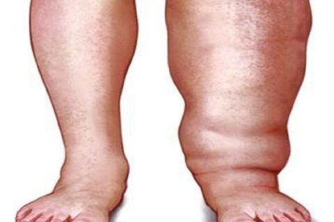 हात्तीपाइले विरुद्ध औषधि सेवन कार्यक्रम सुरु