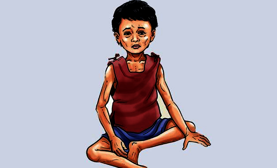  बालबालिकामा कुपोषण बढ्यो